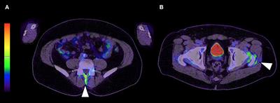 Decision Tree With Only Two Musculoskeletal Sites to Diagnose Polymyalgia Rheumatica Using [18F]FDG PET-CT